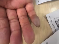 7旬老伯被蟹钳夹伤险截肢 住院12天才脱险[推荐]