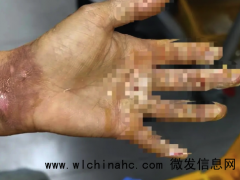 3岁男童掉进炭火堆全身85%烧伤 父母崩溃求助：救救孩子[推荐]