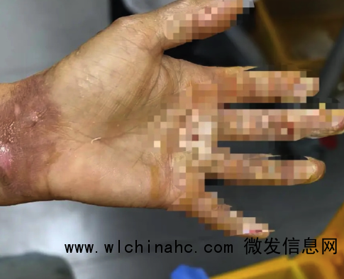 3岁男童掉进炭火堆全身85%烧伤 父母崩溃求助：救救孩子